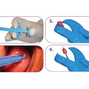 Pinza per Biopsia Cervicale GYN&PUSH 21,5 cm Sterile - 50 pezzi - 2