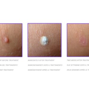 Dispositivo Criochirurgico CryOmega con Cartuccia 16 g Non Ricaricabile - 2