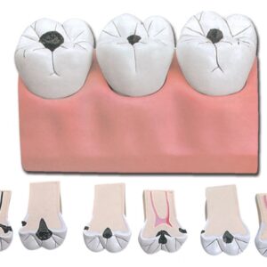 Modello Anatomico Carie Dentale 7 Parti Ingrandimento 4x - 3 pezzi