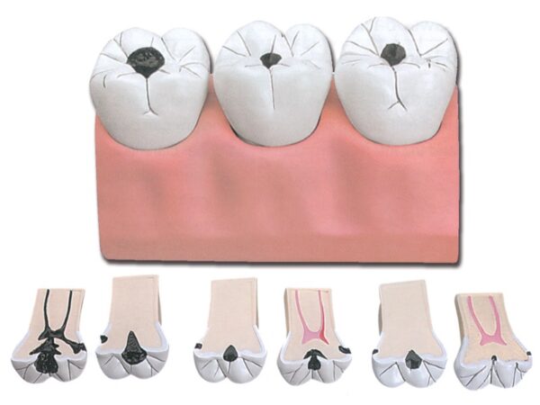 Modello Anatomico Carie Dentale 7 Parti Ingrandimento 4x - 3 pezzi