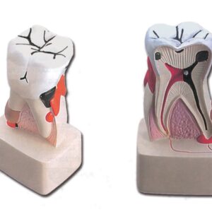 Modello Anatomico Patologia Dentale Processo Carie Ingrandito 4x - 4 pezzi