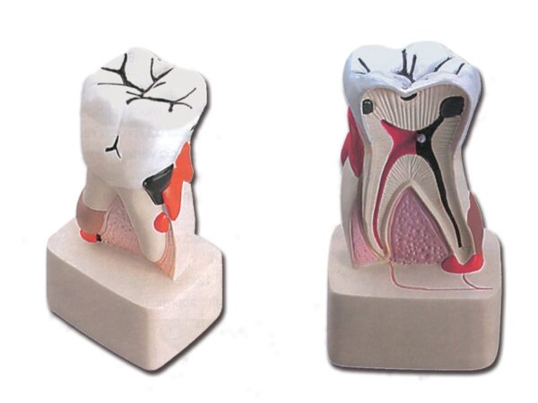 Modello Anatomico Patologia Dentale Processo Carie Ingrandito 4x - 4 pezzi