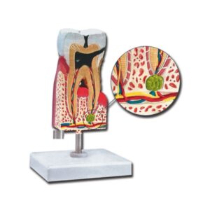 Modello Anatomico Molare Inferiore con Carie Ingrandimento 10x - 3 pezzi