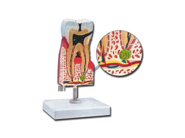 Modello Anatomico Molare Inferiore con Carie Ingrandimento 10x - 3 pezzi