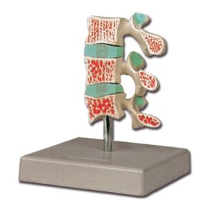 Modello Anatomico Osteoporosi 3 Vertebre - Sana, Iniziale, Avanzata - 3 pezzi