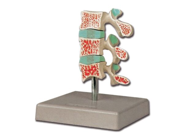 Modello Anatomico Osteoporosi 3 Vertebre - Sana, Iniziale, Avanzata - 3 pezzi