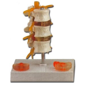 Modello Anatomico Ernia Discale, 3 Vertebre Lombari e Prolasso Disco - 2 pezzi