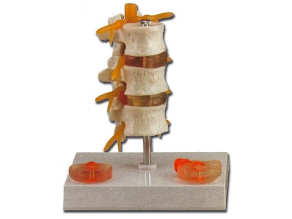Modello Anatomico Ernia Discale, 3 Vertebre Lombari e Prolasso Disco - 2 pezzi